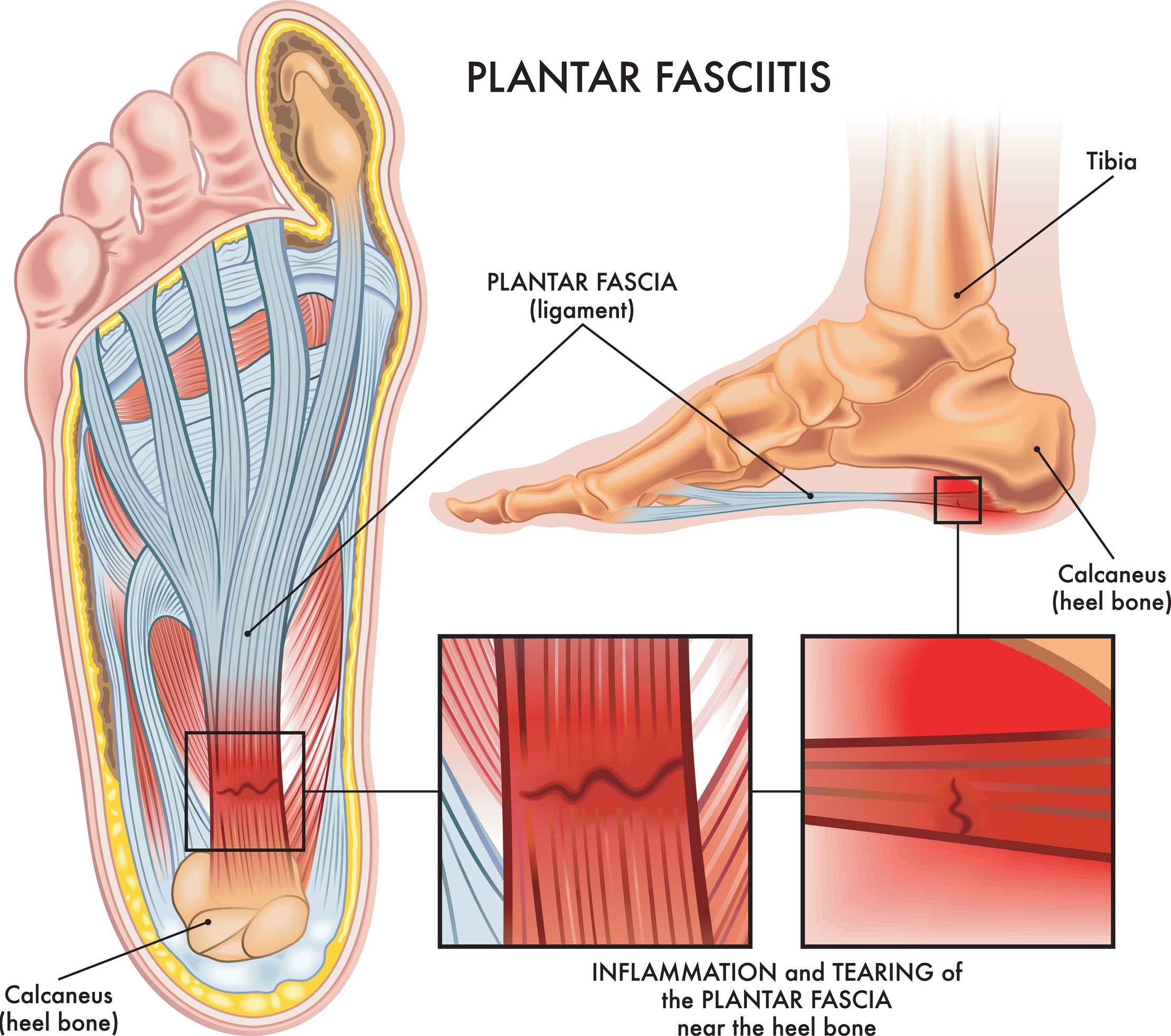 Diagram of plantar fasciitis showing inflammation of the plantar fascia, a thick band of tissue that runs along the bottom of the foot from the heel to the toes. The image highlights the location of the plantar fascia, the common site of heel pain, and how tiny tears in the tissue can lead to discomfort and stiffness, especially in the morning or after long periods of rest.