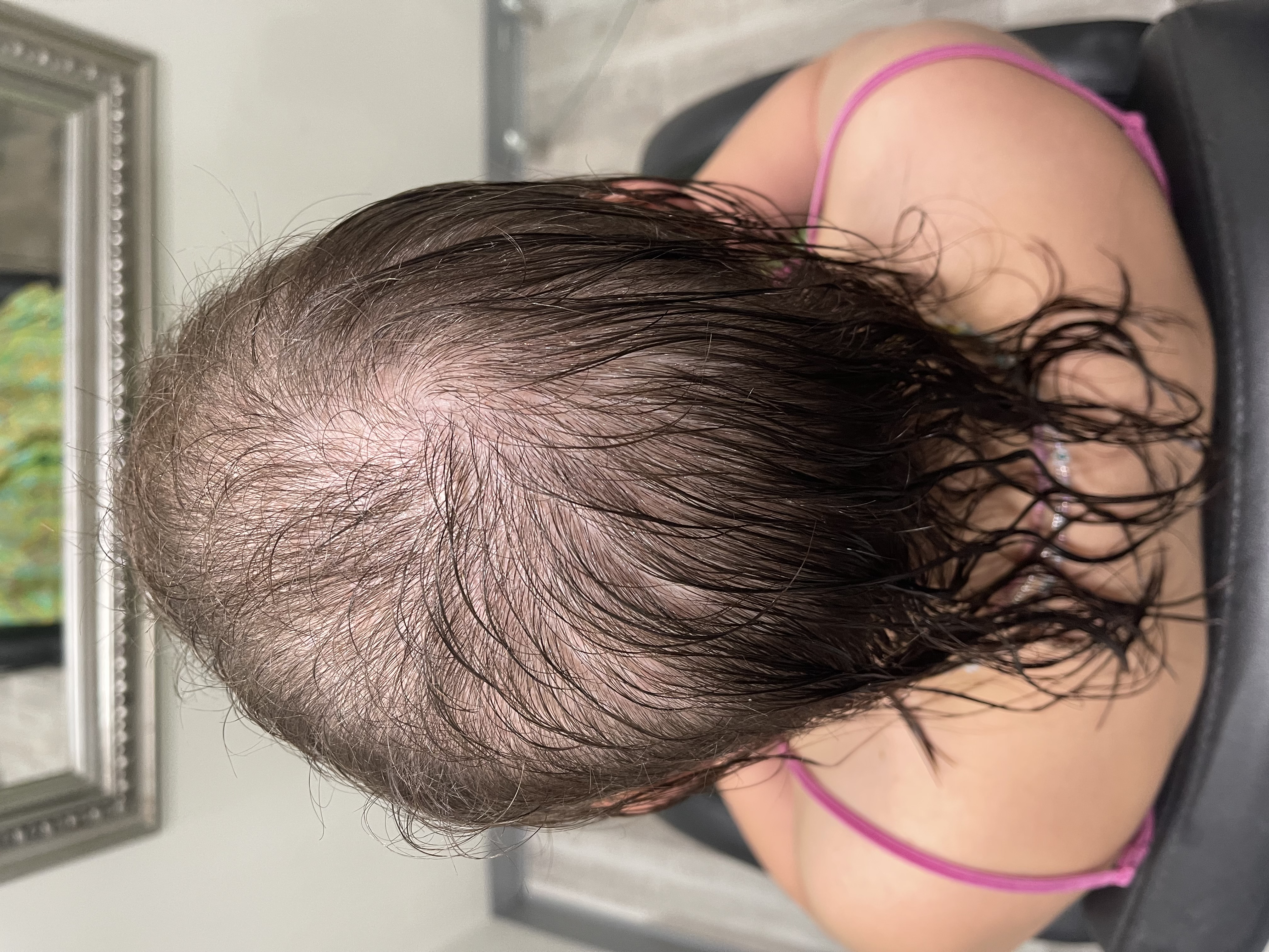 a young woman with female pattern baldness in the 20s