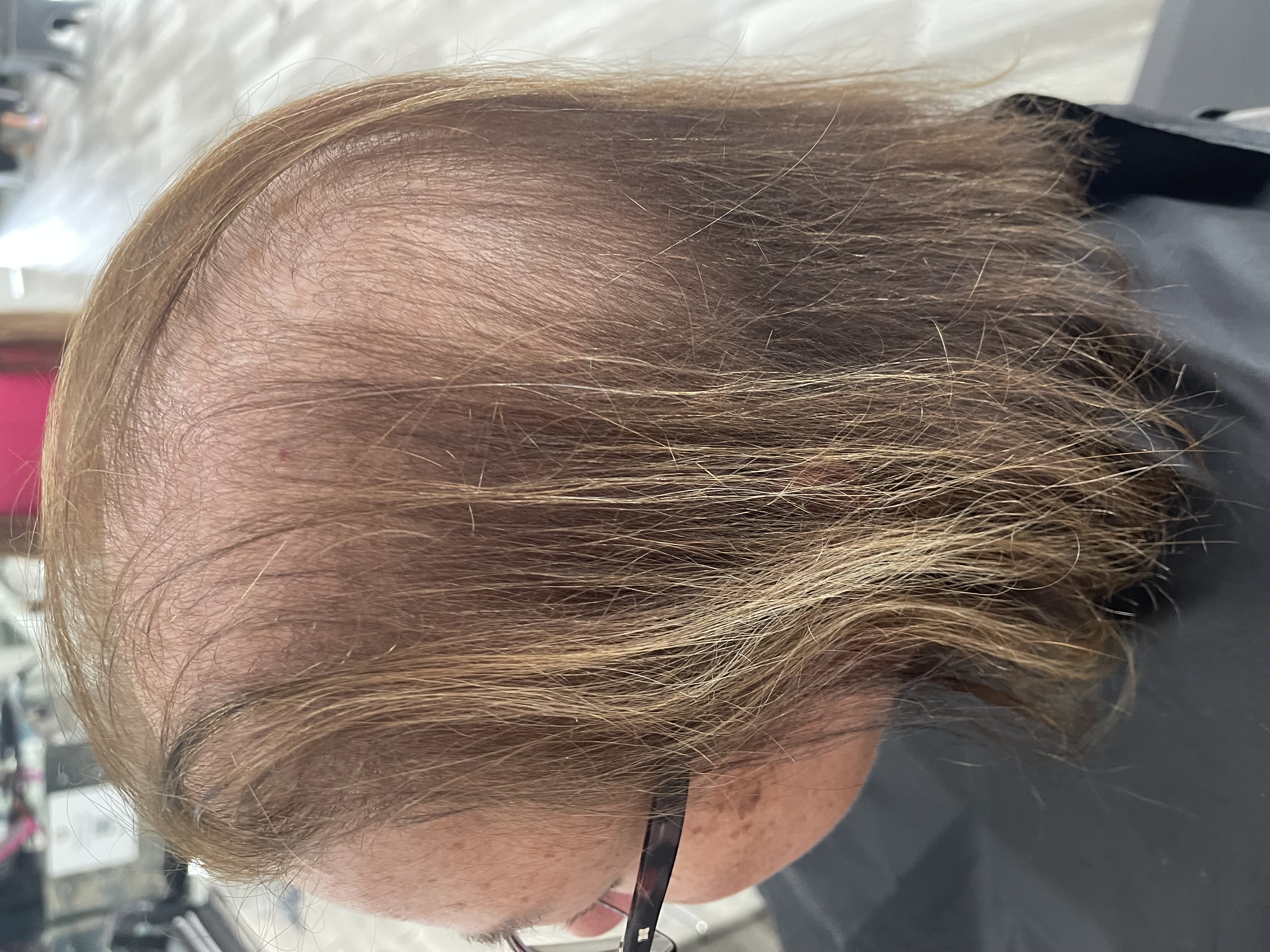 A woman with hair loss due to Telogen Effluvium