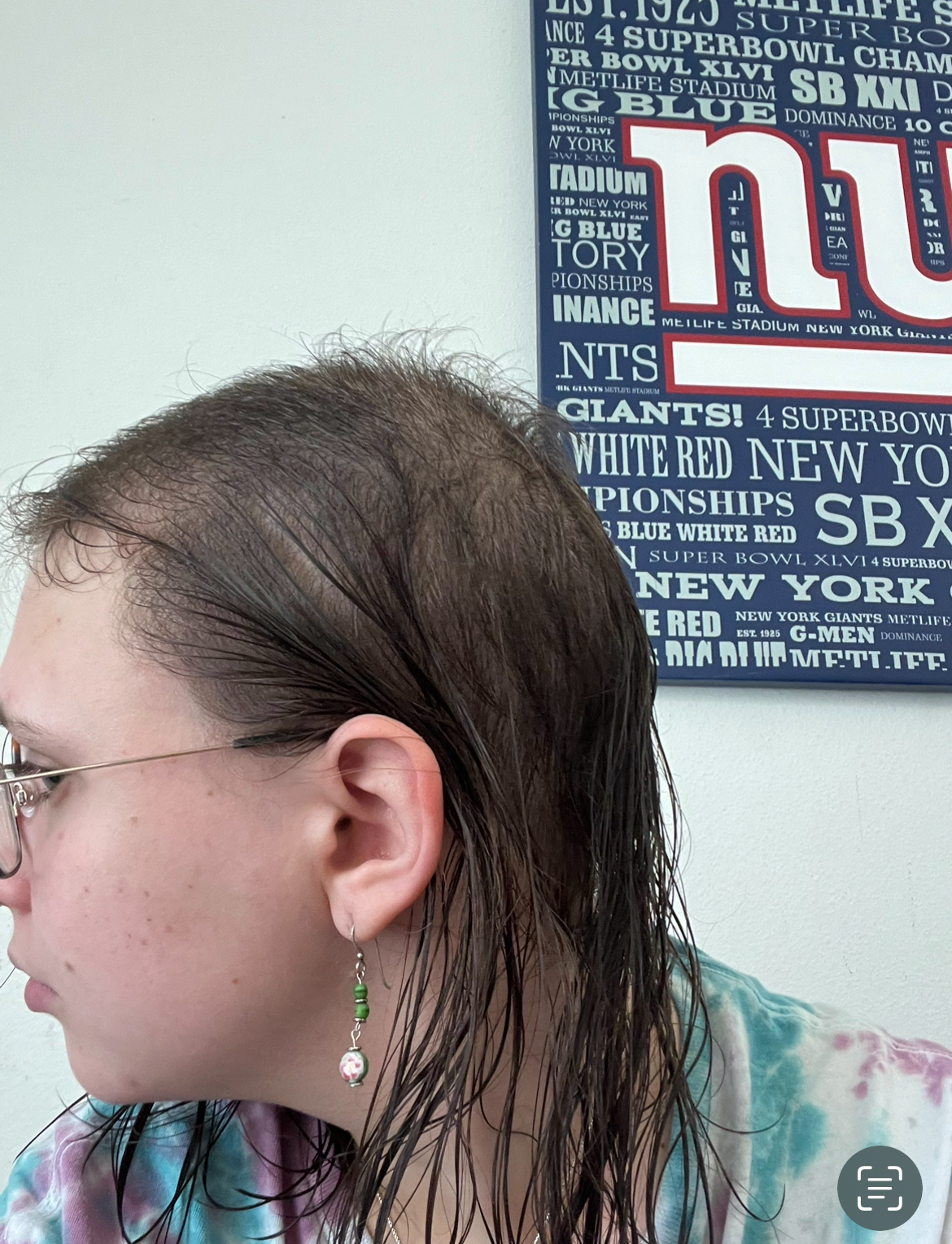 a young woman with Trichotillomania