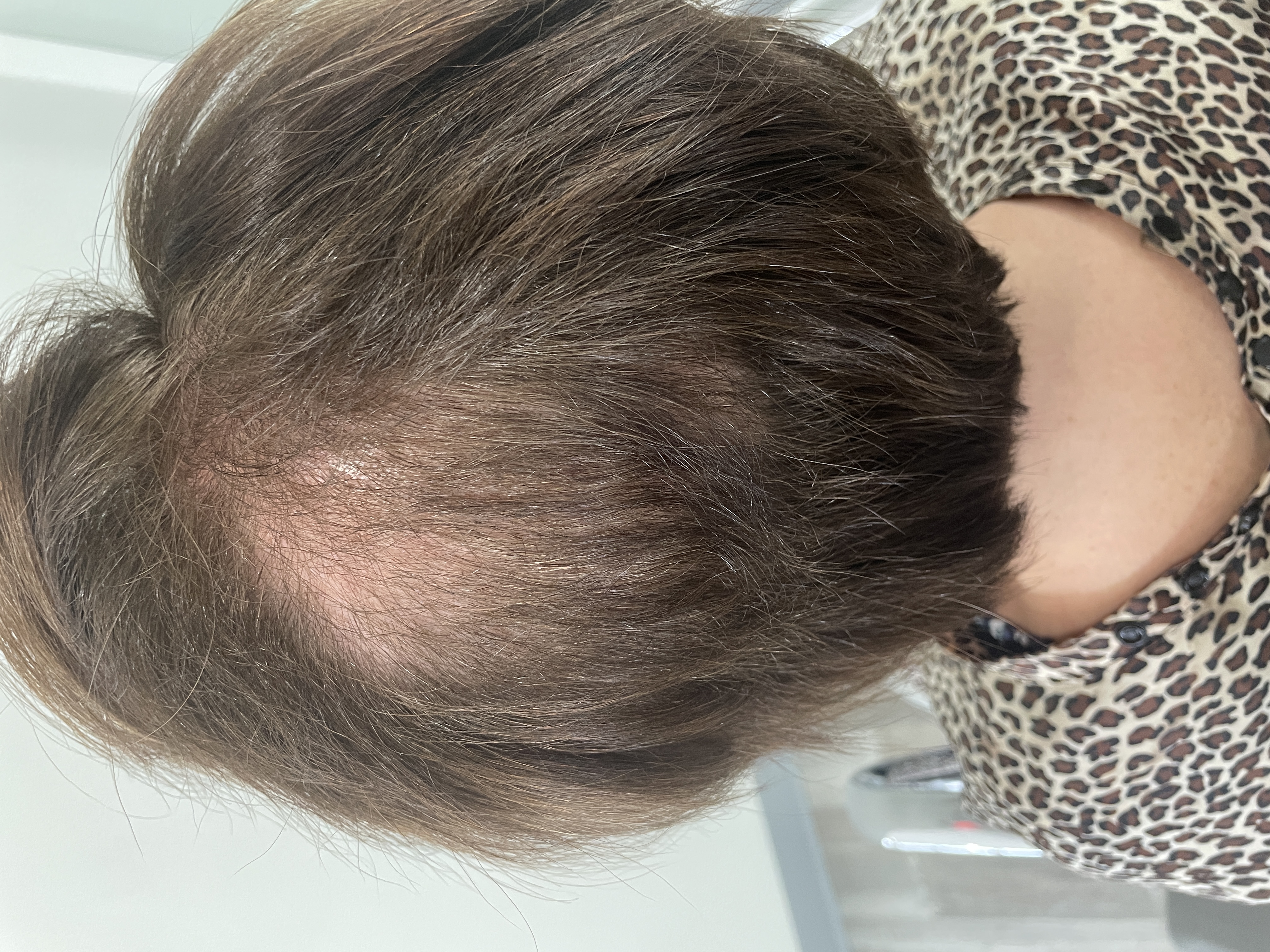 a woman with a bald spot due to trichotillomania