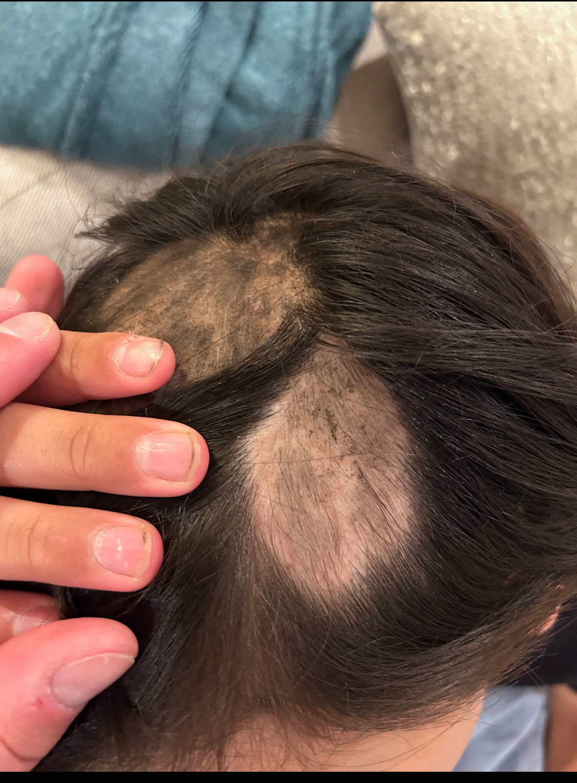 a boy with alopecia areata taking hair loss medication