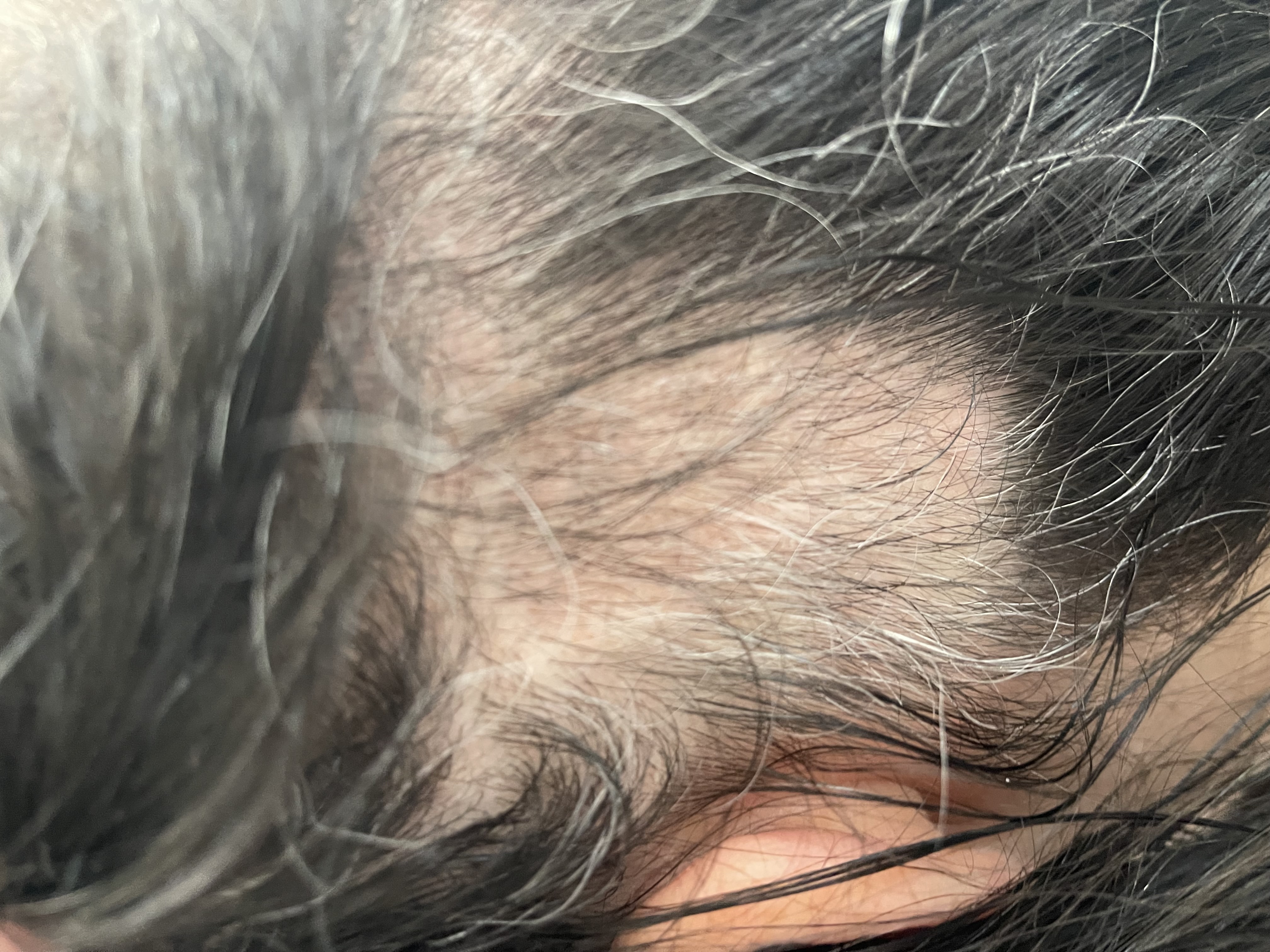 A woman with twisted Hair Syndrome