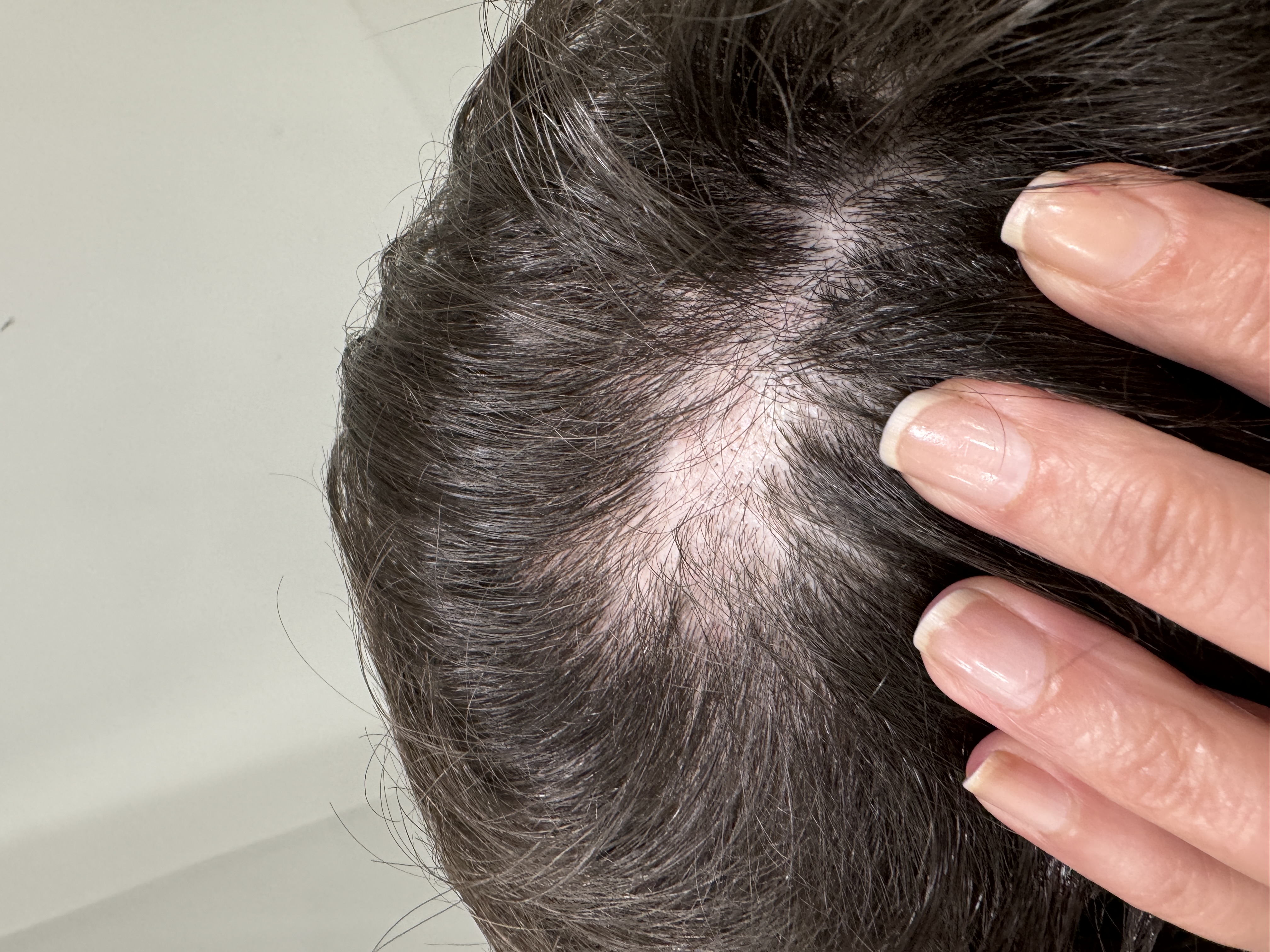 hair loss from trichotillomania