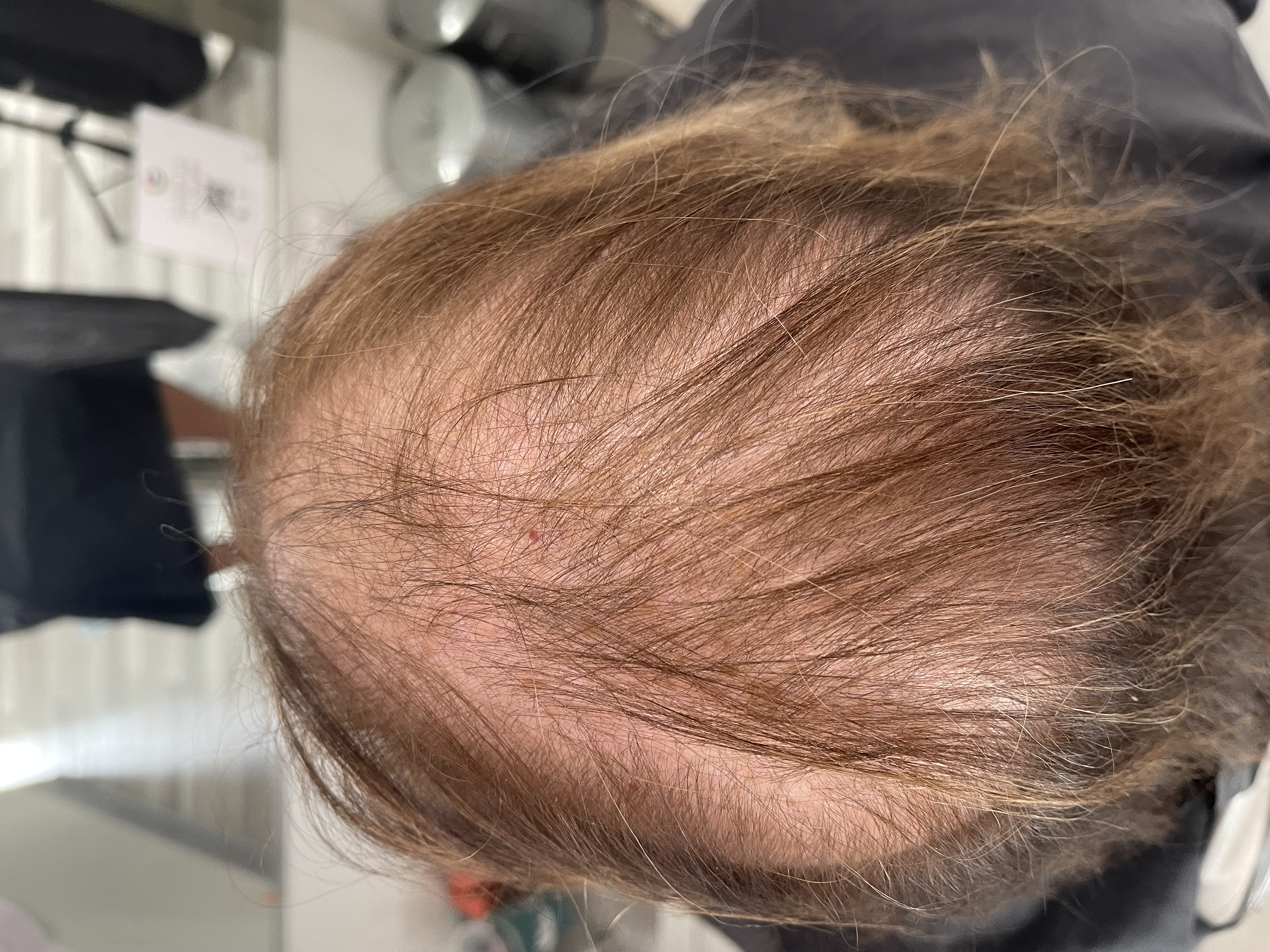 a woman with hair loss due to rapid weight loss
