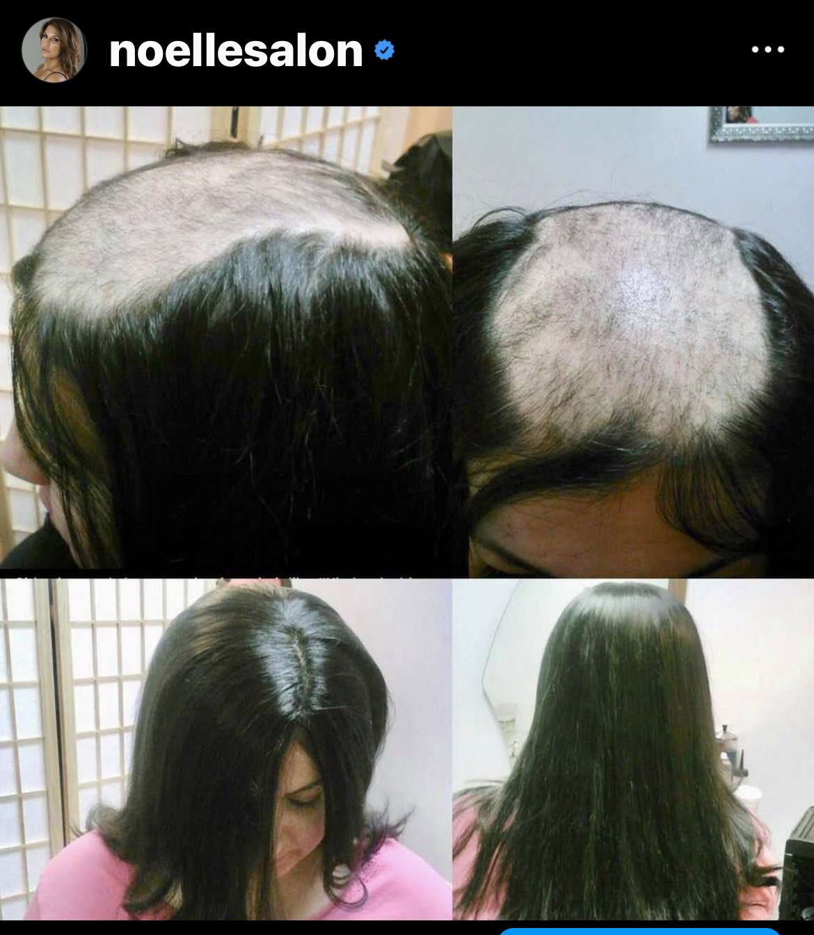a woman with female pattern baldness wearing a hair topper