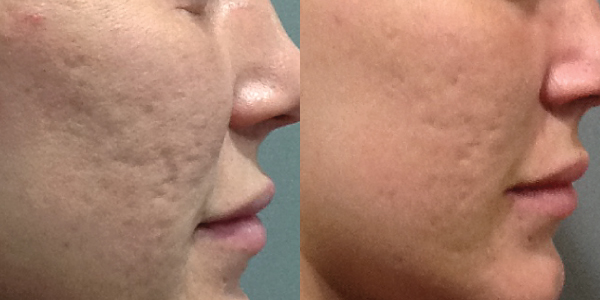 Microneedling Before and After for Acne Scars
