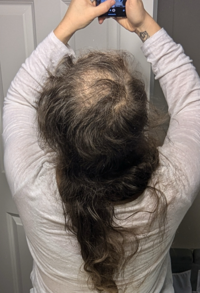 a photo of a person with Trichotillomania