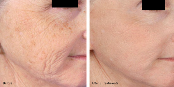 Microneedling Before and After 3 Treatments