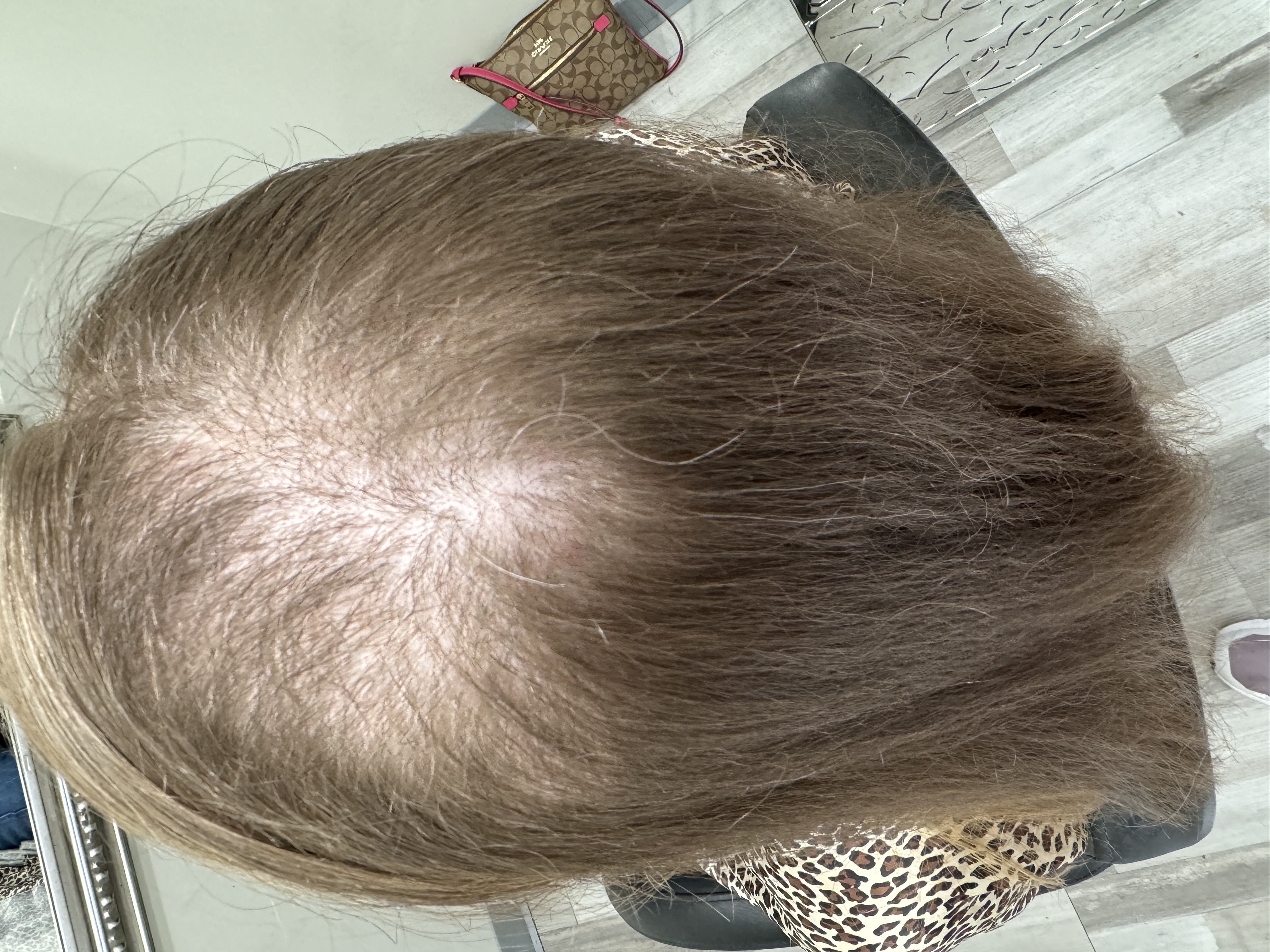 a picture of a person with Trichotillomania hair pulling disorder