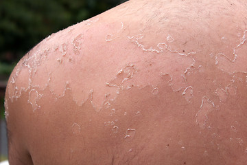 Image showing Peeling Sunburned Back