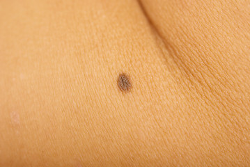 Image showing mole