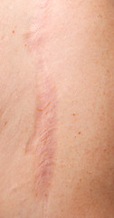 Image showing skin scar