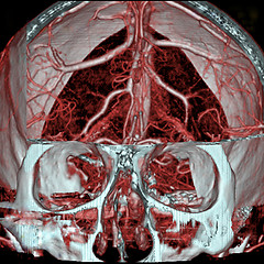 Image showing A real MRI/ MRA (Magnetic Resonance Angiogram) of the brain vasculature (arteries).  This MRI study is  often used to show/find brain aneurysms.