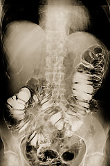 Image showing Irrigoscopy