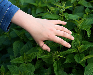 Image showing Nettle sting a skin