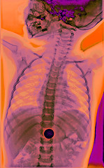 Image showing This is a colorized x-ray of a child who swallowed money (penny). Many visits to the ER by kids are for FBOs (Foreign Body Objects).  He did fine.  Colors carefully rendered to show anatomy.