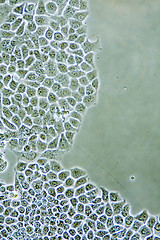 Image showing Ductal Breast Cancer cells