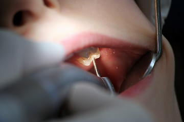 Image showing Dentist at work