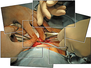 Image showing Surgeons' Hands Collage- A real operation showing a thyroidectomy.