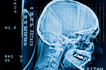 Image showing Closeup of a CT scan with brain and skull on it