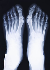 Image showing feet xray