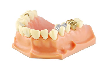 Image showing Dental model (with different treatments)