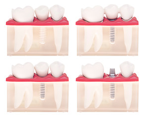 Image showing Implant dental model