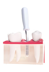 Image showing Implant dental model