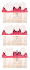 Image showing Implant dental model