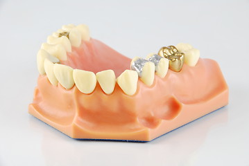 Image showing Dental model (with different treatments)