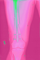 Image showing Xray of Femur Fracture Repair after a motorcycle accident. The long rod is held in place by nails.