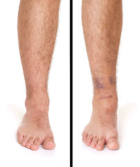 Image showing Ankle Sprain