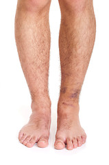 Image showing Ankle Sprain