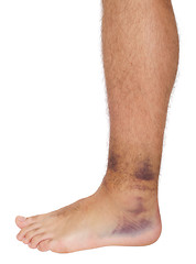Image showing Ankle Sprain