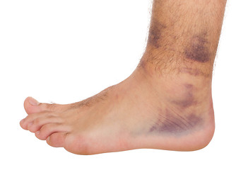 Image showing Ankle Sprain