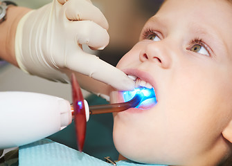 Image showing dental filing of child tooth by ultraviolet light