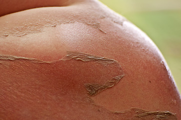 Image showing Sunburn, peeling skin.