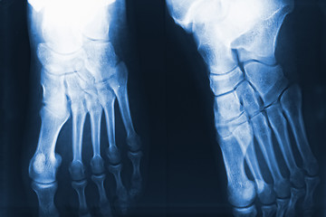 Image showing feet xray