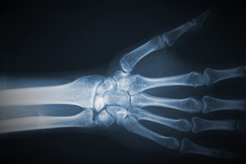 Image showing hand xray