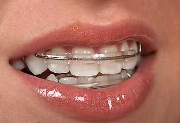 Image showing Cosmetic Braces