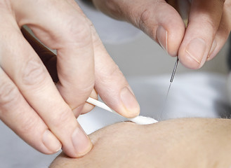 Image showing Acupuncture needle in skin