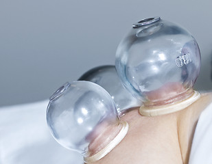 Image showing Cupping therapy in traditional chinese medicine