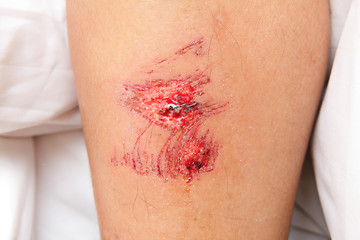 Image showing wound