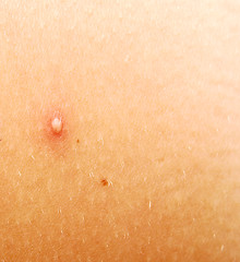 Image showing pimple