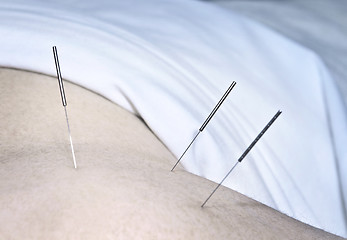 Image showing Acupuncture needles in shoulder