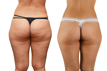 Image showing cellulite buttocks