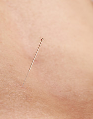Image showing Acupuncture needle
