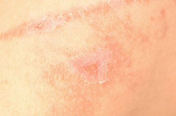 Image showing bad skin