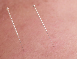 Image showing Acupuncture needles